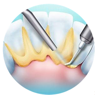 Зубной камень удаление. Профилактика зубного камня. Ирригатор убирает ли зубной камень.