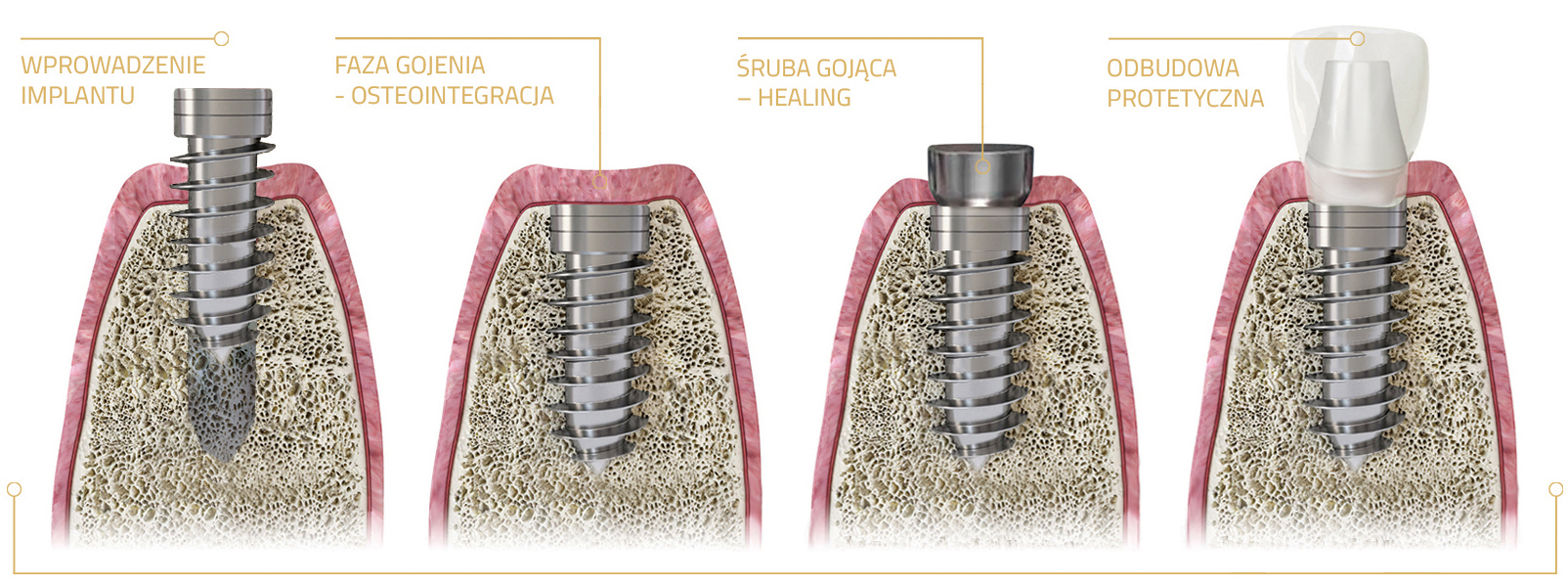 Зубы импланты поэтапно. Двухэтапная методика имплантации. Двухэтапная имплантация зубов этапы. Зубной имплант формирователь. Формирователь десны на имплант что такое.