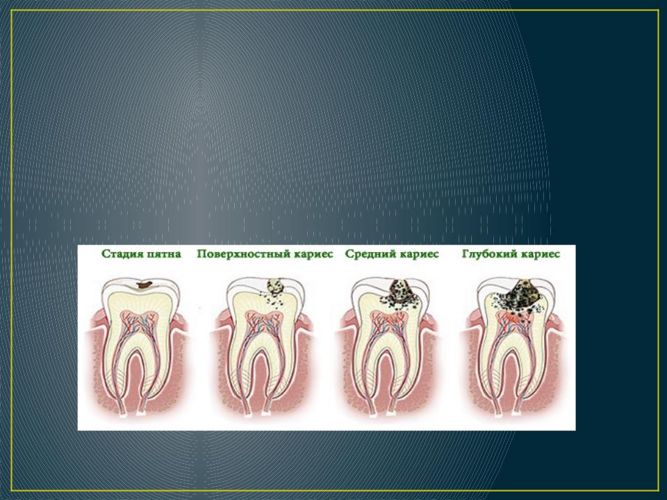 Стадии кариеса. Стадии образования кариеса. Стадии образования кари. Презентация на тему кариес. Кариес стадии процесса.