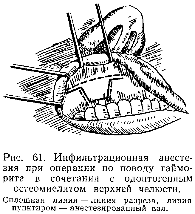 Анестезия губы