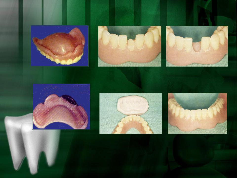 Протезное ложе. Адаптация к зубным протезам. Протезное ложе в ортопедической стоматологии.