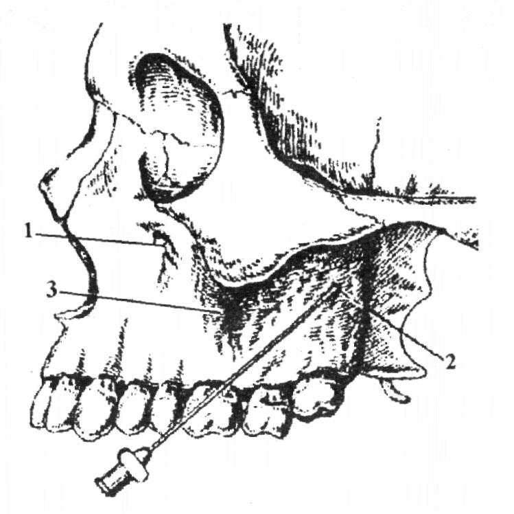 Клыковой ямки. Туберальная анестезия верхней челюсти зона обезболивания. Инфраорбитальная анестезия верхней челюсти. Туберальная проводниковая анестезия. Проводниковая анестезия верхнечелюстного нерва.