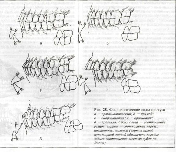 Виды прикуса. Неправильный прикус вид сбоку. Правильный прикус у человека схема сбоку. Классификация прикуса: физиологический прикус патологический прикус. Глубокий прикус схема сбоку.