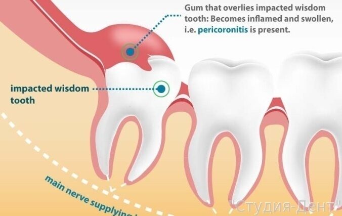 Болит десна возле зуба мудрости