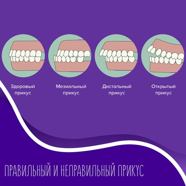 Правильный прикус у человека схема сбоку