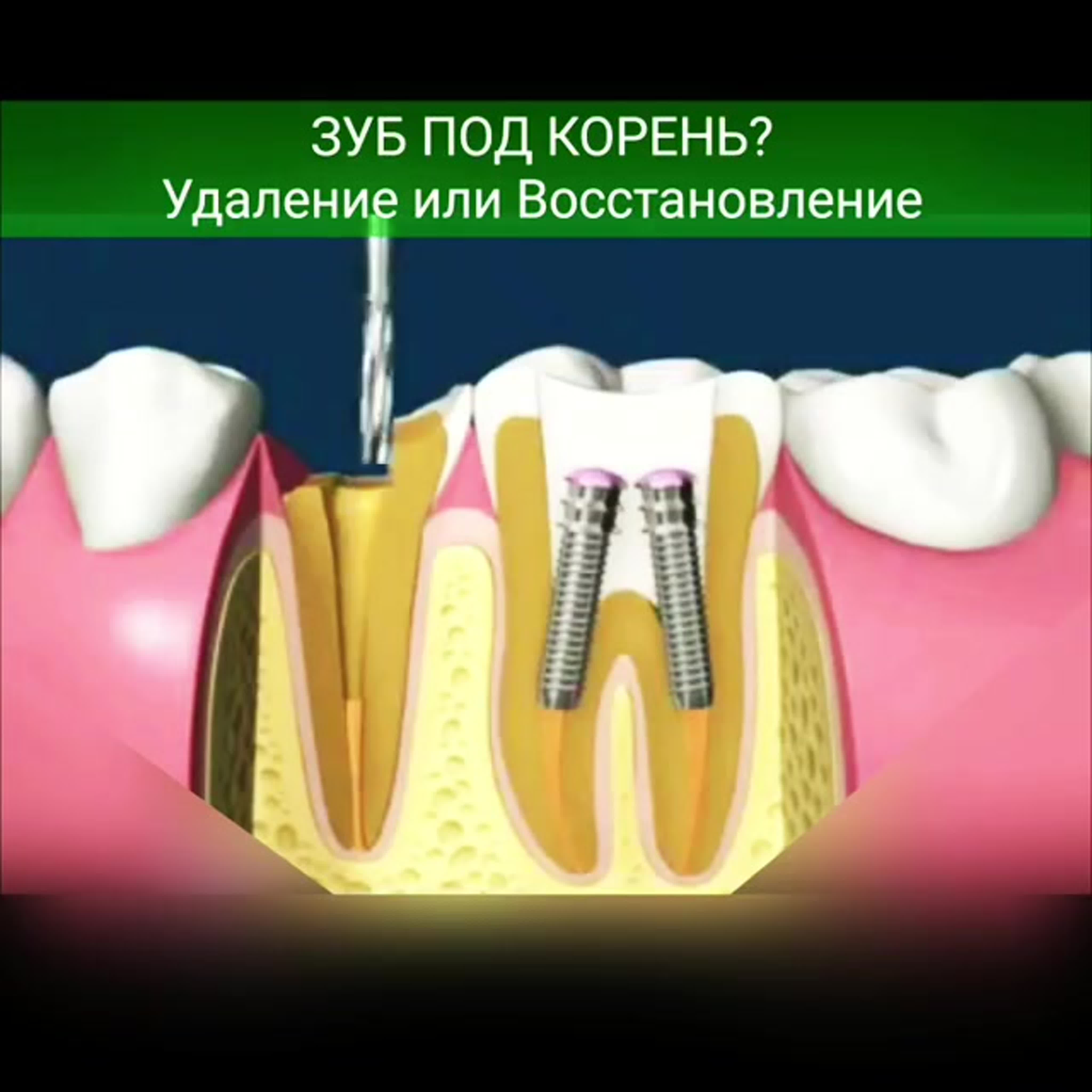Восстановление корня зуба