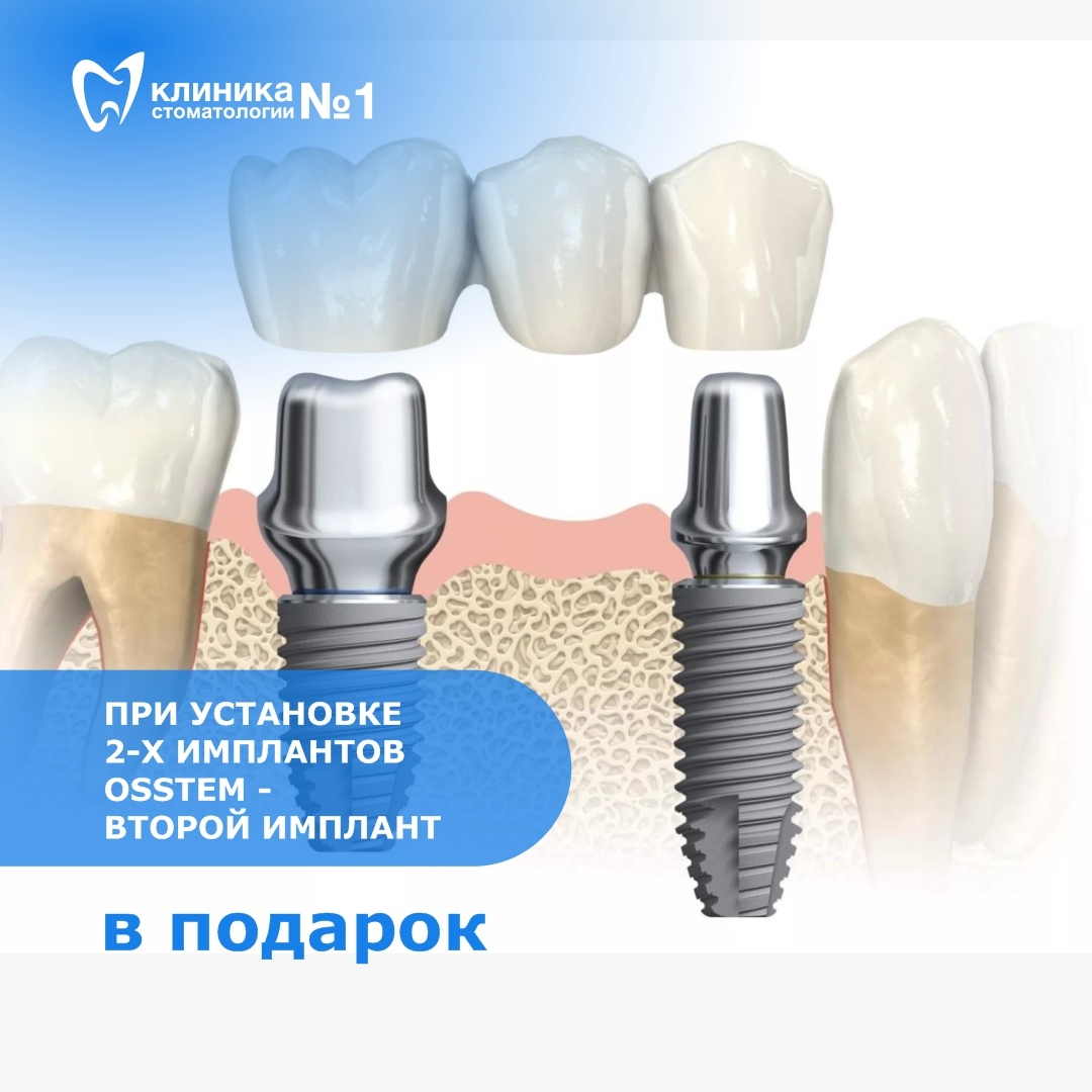 Хорошие импланты отзывы. Имплантация Osstem. Установка имплантата Osstem.