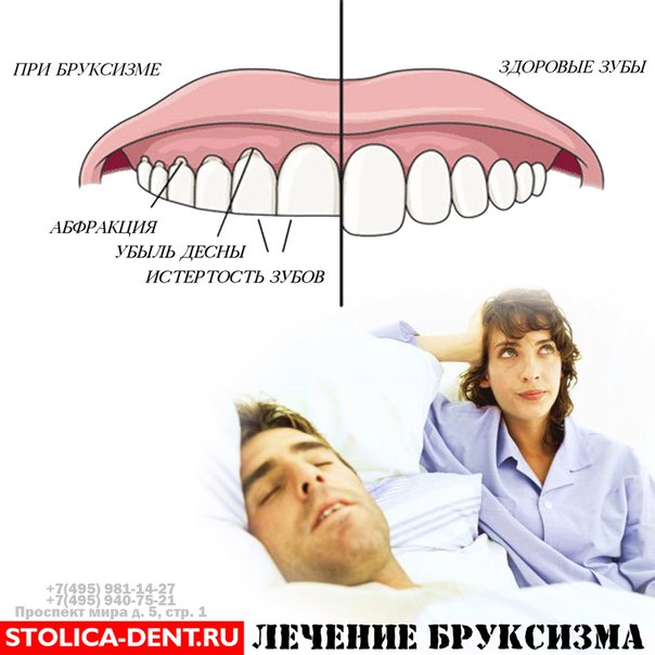 Почему когда спишь скрипишь зубами. Бруксизм у взрослых психосоматика. Скрежет зубами по ночам.