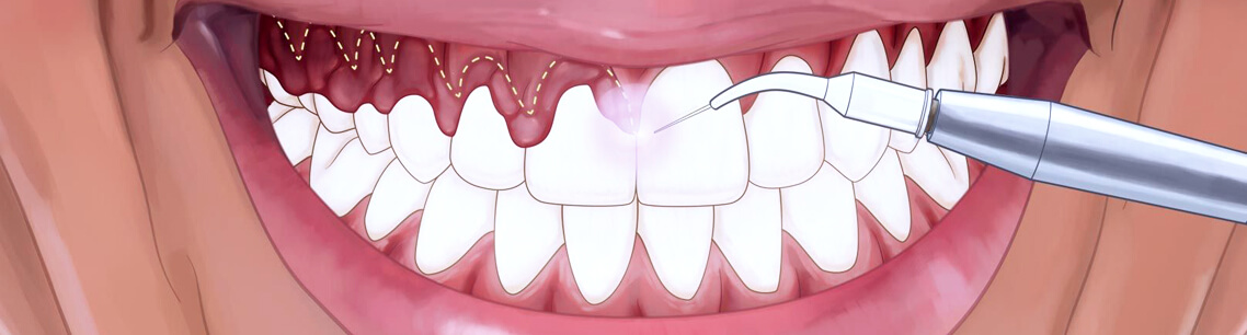 Гингивэктомия в лазерной стоматологии