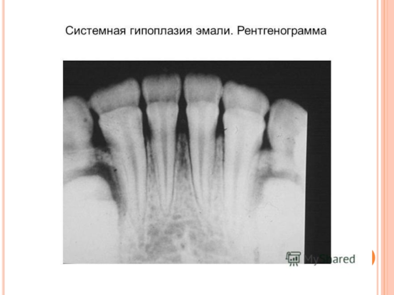 Гипоплазия эмали презентация