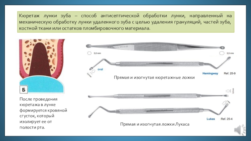 Сколько удаляют зуб. Кюретаж удаленного зуба. Отсроченный кюретаж лунки удаленного зуба.