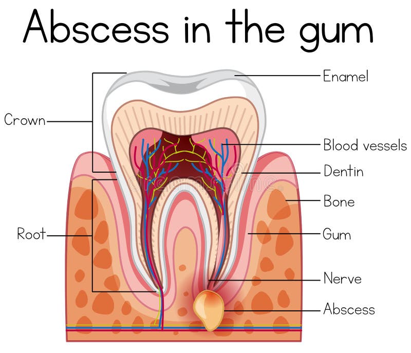 Abscess in the Gum Diagram. Illustration vector illustration