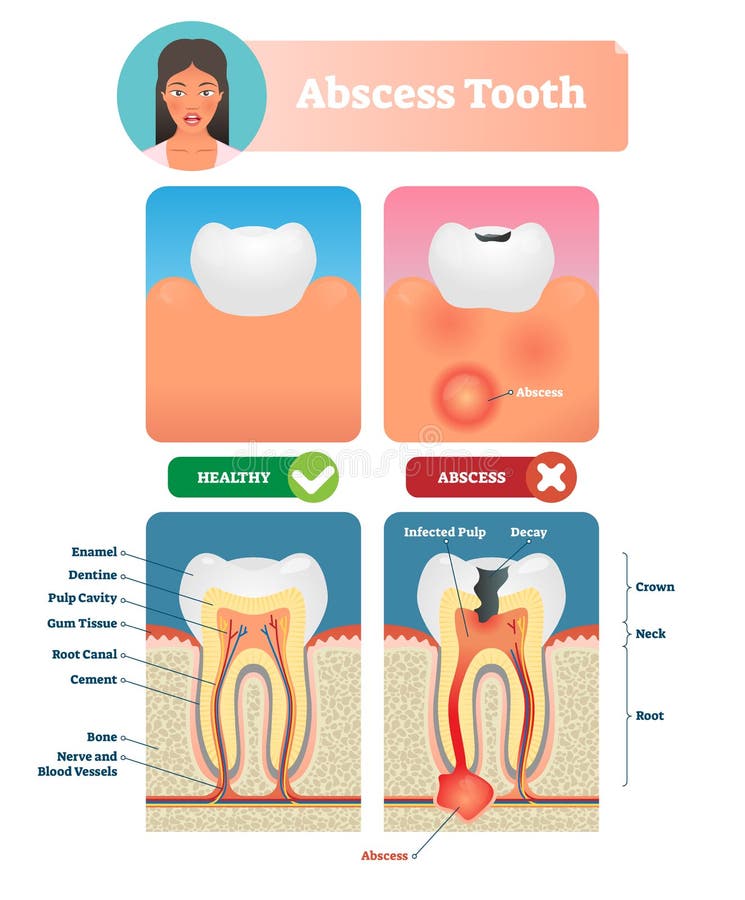 Abscess tooth vector illustration. Labeled medical diagram with structure. Compared isolated infected root canal with healthy. Personal oral mouth hygiene to stock illustration