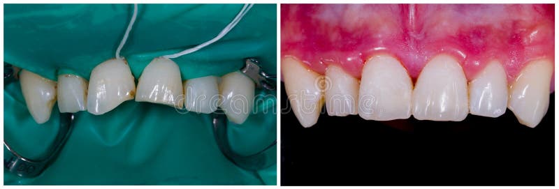 Aesthetic and function with direct composite. Mimicking nature - regaining aesthetics and function on broken central incisors royalty free stock photography