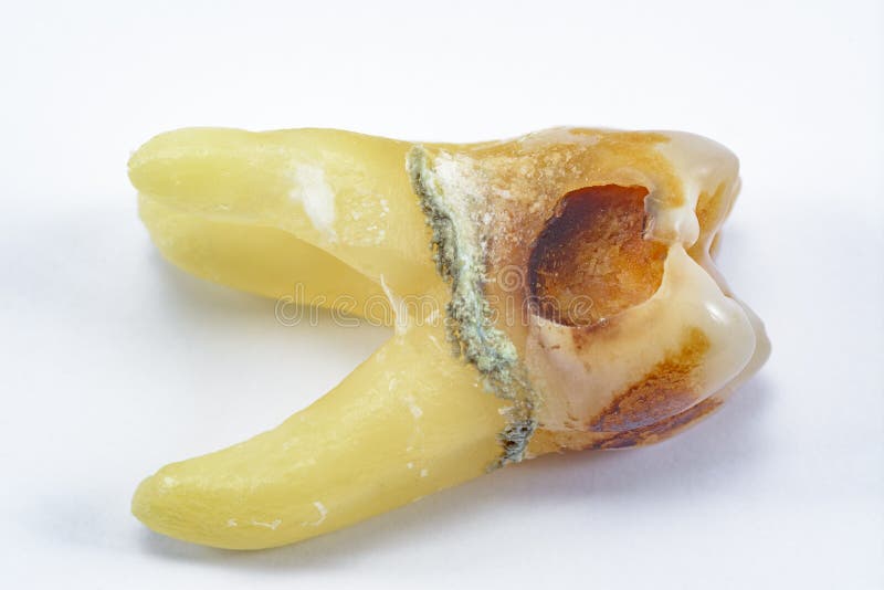 Affected by caries, destroyed with a large cavity, removed human tooth with large roots, chewing molar tooth, wisdom tooth, tooth. Extraction operation, dental royalty free stock photos