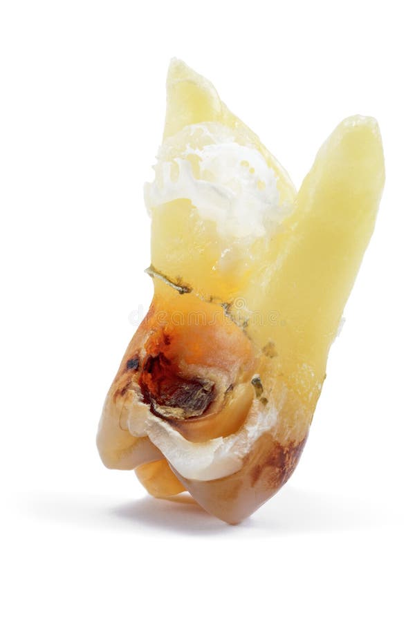 Affected by caries, destroyed with a large cavity, removed human tooth with large roots, chewing molar tooth, wisdom tooth, tooth. Extraction operation, dental stock photo