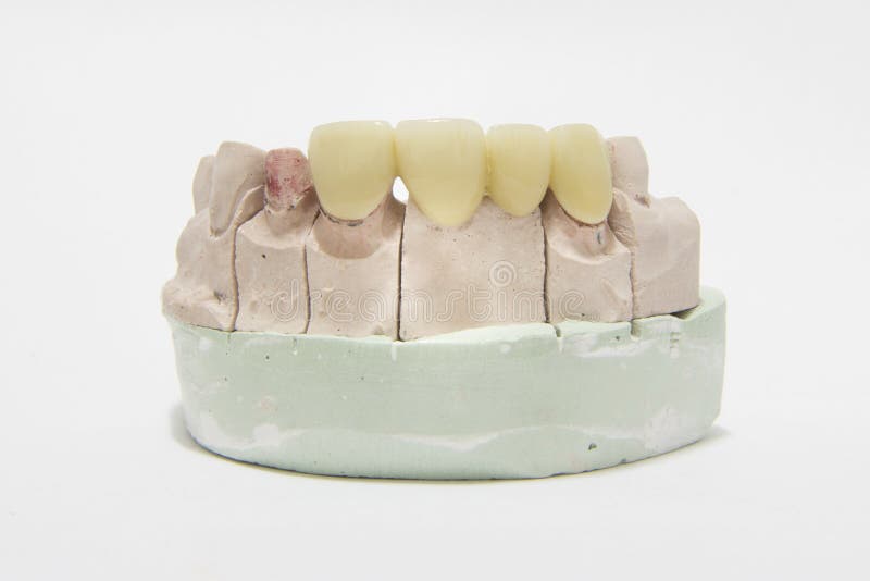 All ceramic highly aesthetic dental bridge and crown on model royalty free stock photography