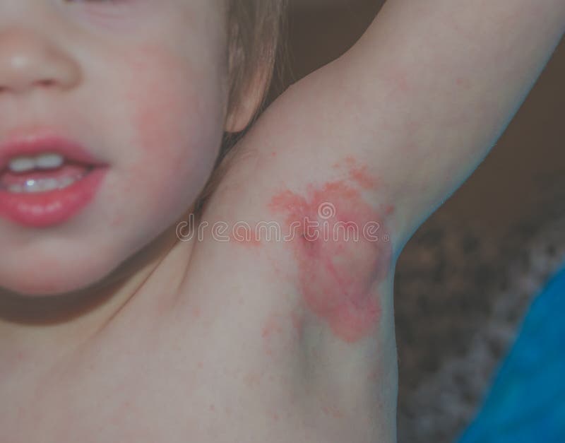 The child in the armpit inflammation, mum wiping cloth. Allergy in children in the axilla royalty free stock image
