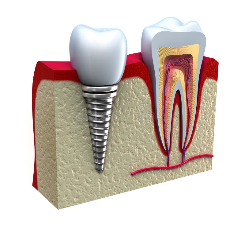 Anatomy of healthy teeth and dental implant stock illustration