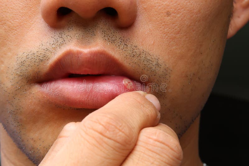 Aphthous stomatitis ,lip leison. asians human face. Pointing at lips royalty free stock photography