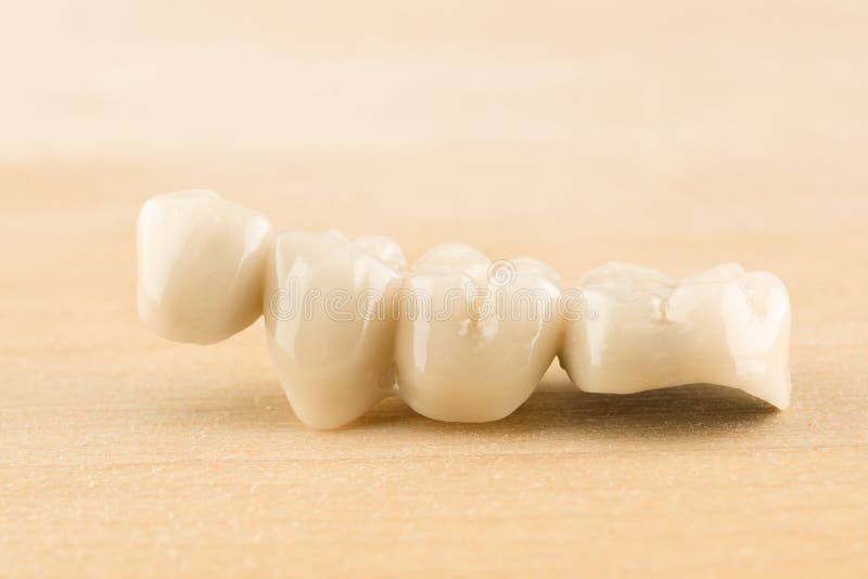 Cermet dental bridges. Artificial dental structures made of ceramics for restoration of dentition stock images