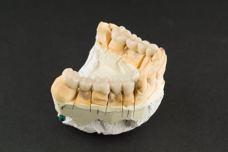 Cermet dental bridges. Artificial dental structures made of ceramics for restoration of dentition royalty free stock photos