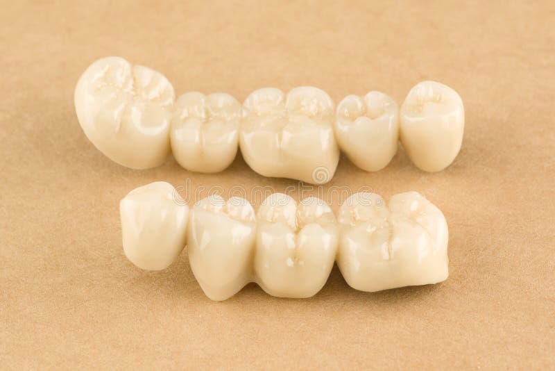 Cermet dental bridges. Artificial dental structures made of ceramics for restoration of dentition royalty free stock image