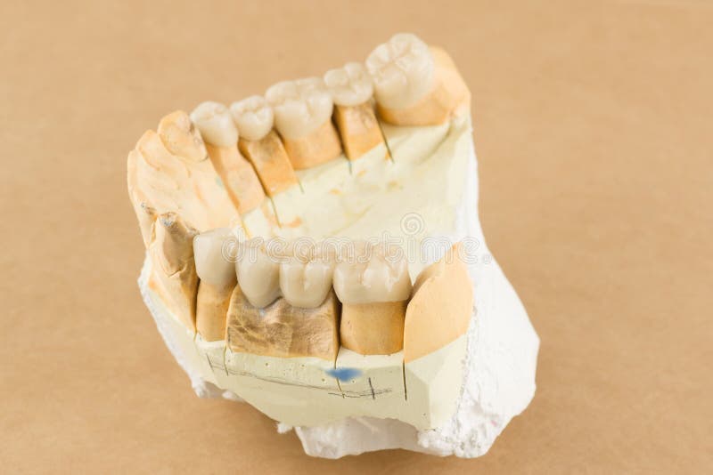 Cermet dental bridges. Artificial dental structures made of ceramics for restoration of dentition stock photo