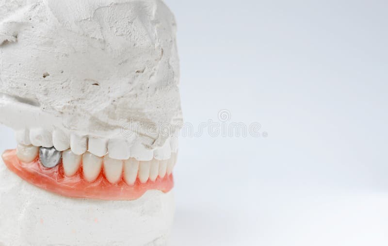 Artificial tooth, dental prosthesis with false silver tooth, metalic crown on tooth. stock photography