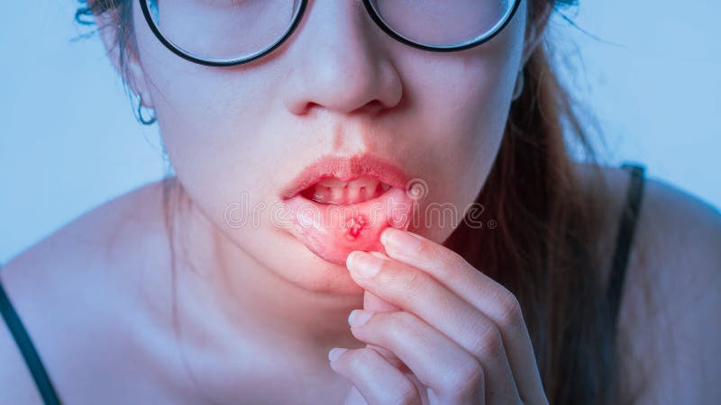 Asian women have aphthous ulcers on mouth, selective focus.  stock images