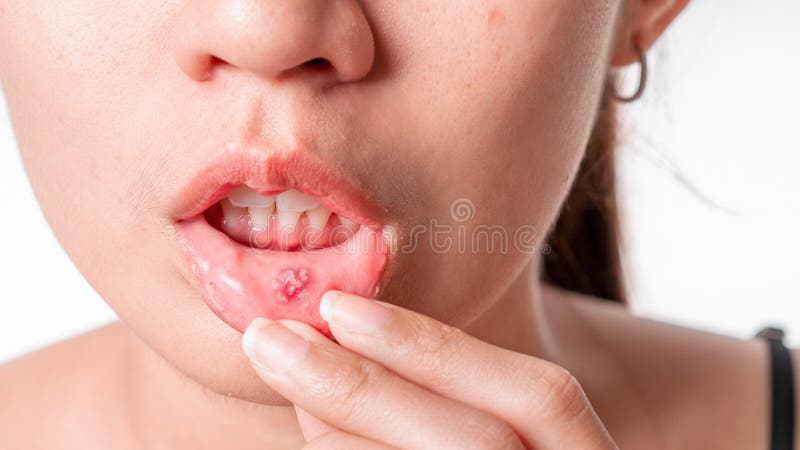 Asian women have aphthous ulcers on mouth on white background, selective focus.  royalty free stock photography