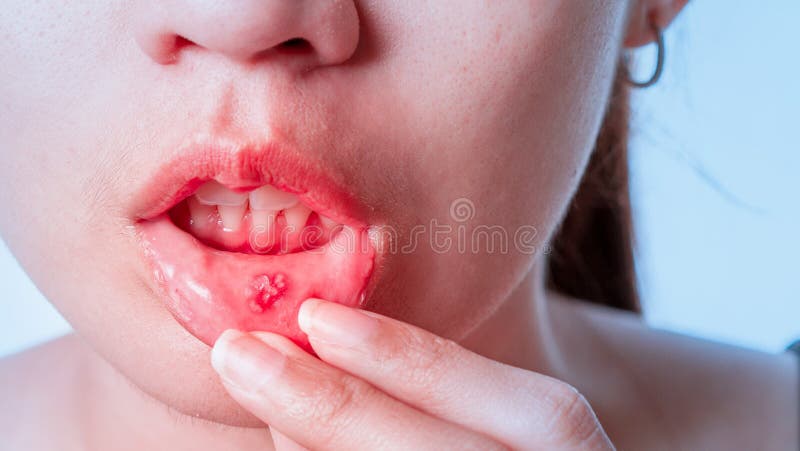 Asian women have aphthous ulcers on mouth on white background, selective focus.  royalty free stock photos