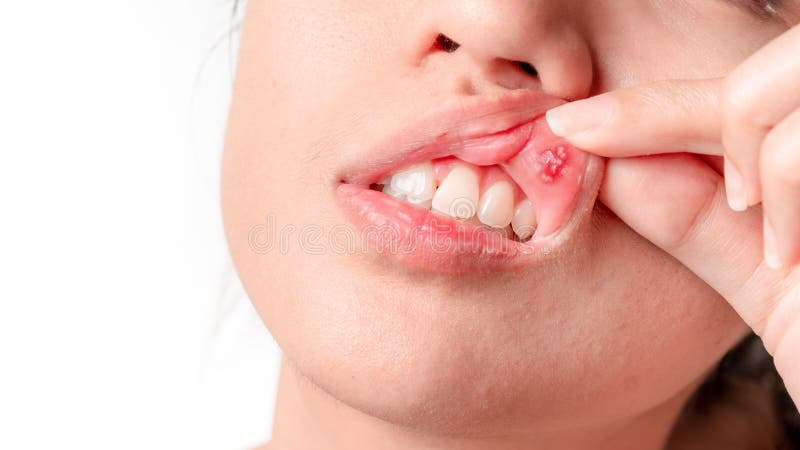 Asian women have aphthous ulcers on mouth on white background, selective focus.  stock photo