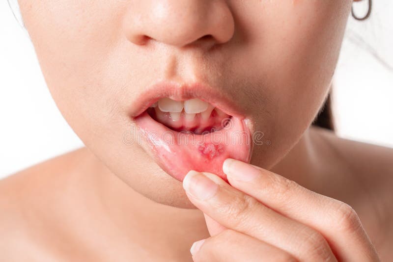 Asian women have aphthous ulcers on mouth on white background, selective focus.  stock photo