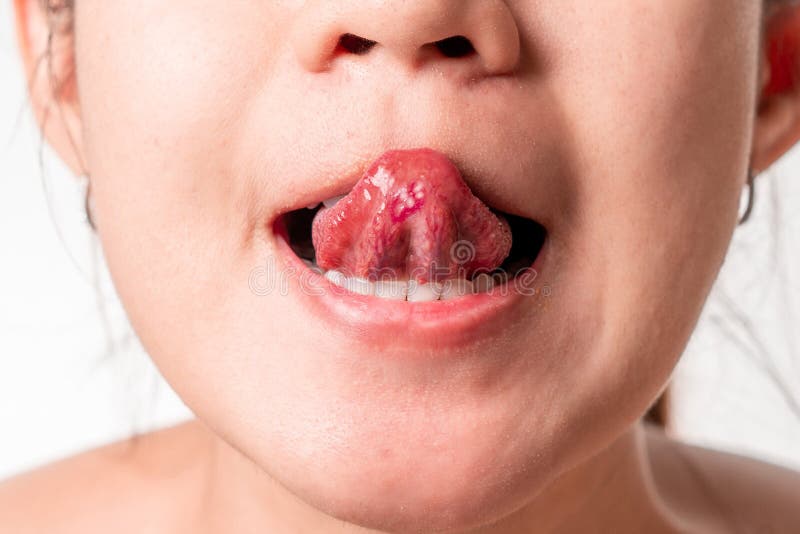Asian women have aphthous ulcers on tongue on white background, selective focus.  stock image