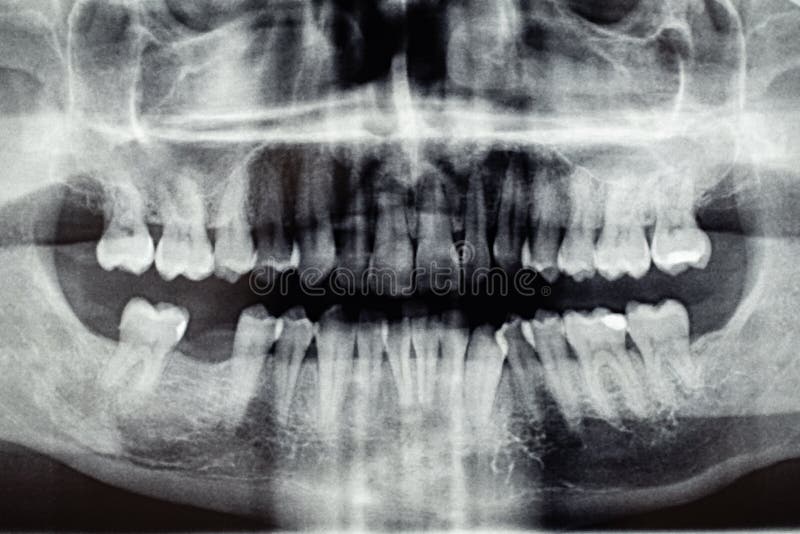 Panoramic dental X-Ray, one back tooth hole stock photo