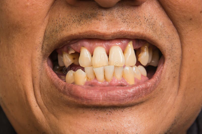 Плохие зубы 