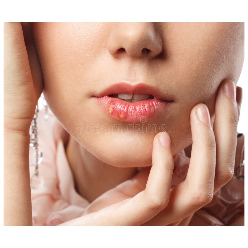 Beautiful lips infected herpes virus stock photography