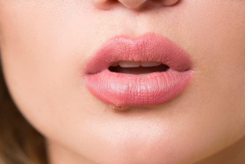 Beautiful lips virus infected herpes stock photos