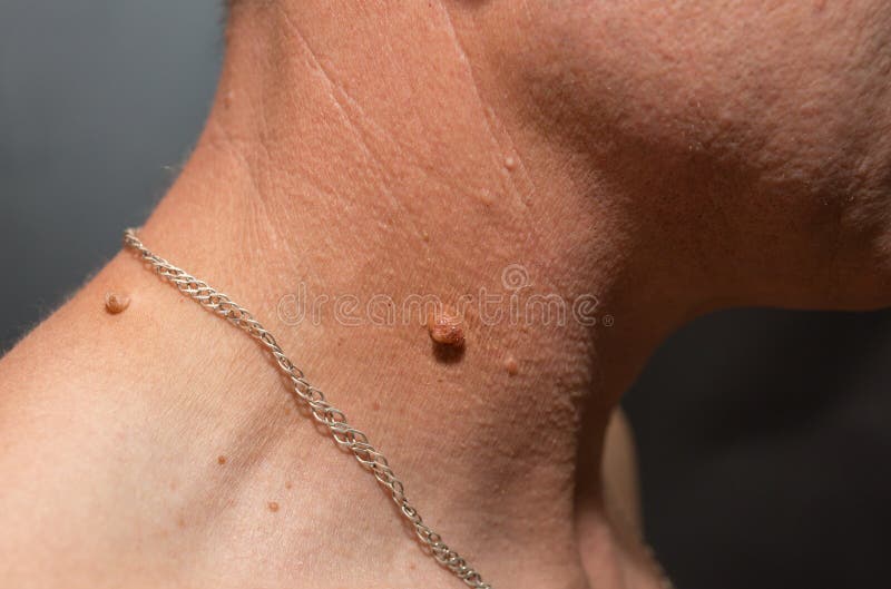 Big birthmark on the man` skin. Medical health papilloma photo.  royalty free stock photos