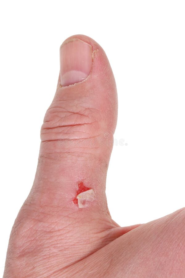 A big dirty finger of a worker with a bloody callus from a shove stock photo