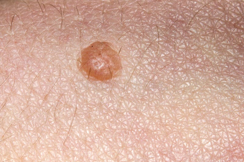 Birthmark, papilloma or benign tumor on the skin of young woman close-up. Birthmark, papilloma or benign tumor on the skin of a young woman close-up stock photography