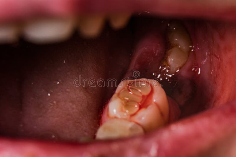 Bloody tooth plucked out royalty free stock photos