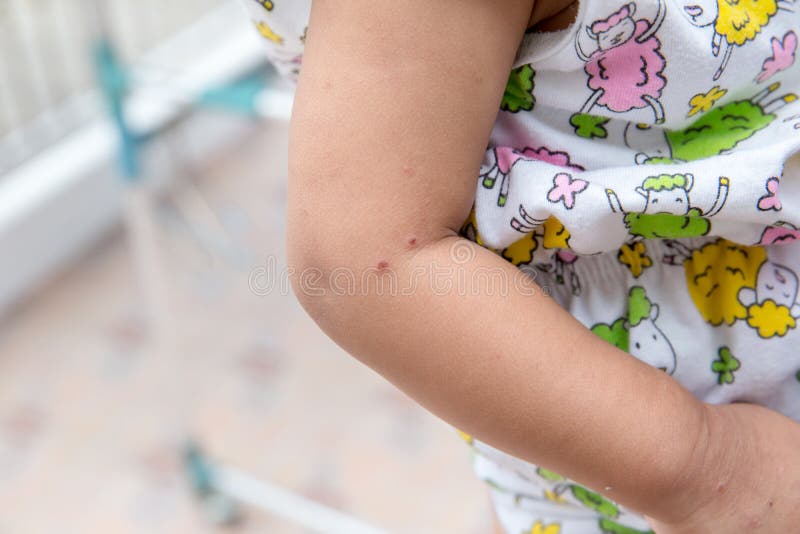 Boy with symptoms hand, foot and mouth disease . children ` HFMD ` with disease .Mouth Foot and Mouth Disease caused by a strain. Boy with symptoms hand, foot royalty free stock photo