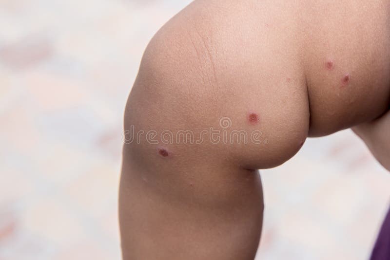 Boy with symptoms hand, foot and mouth disease . children ` HFMD ` with disease .Mouth Foot and Mouth Disease caused by a strain. Boy with symptoms hand, foot royalty free stock images