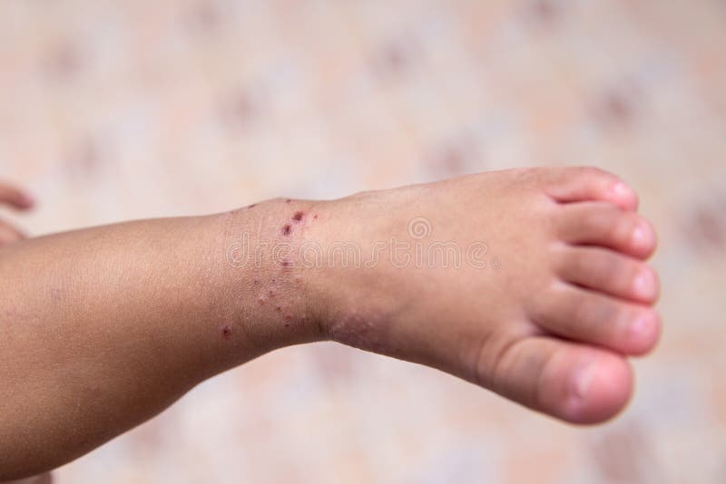 Boy with symptoms hand, foot and mouth disease . children ` HFMD ` with disease .Mouth Foot and Mouth Disease caused by a strain. Boy with symptoms hand, foot royalty free stock image