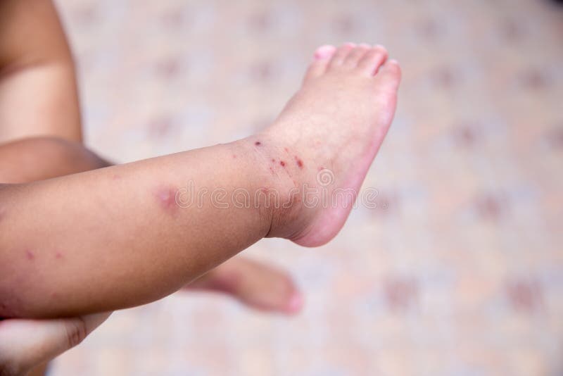 Boy with symptoms hand, foot and mouth disease . children ` HFMD ` with disease .Mouth Foot and Mouth Disease caused by a strain. Boy with symptoms hand, foot royalty free stock photo