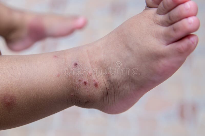 Boy with symptoms hand, foot and mouth disease . children ` HFMD ` with disease .Mouth Foot and Mouth Disease caused by a strain. Boy with symptoms hand, foot stock images