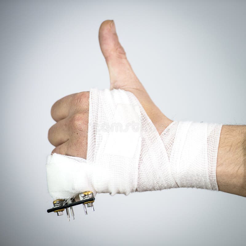 Broken pinky. Bandaged hand with a broken pinky finger with an external rig fixture made from surgical steel pins and a carbon rod, making a thumbs up stock photos