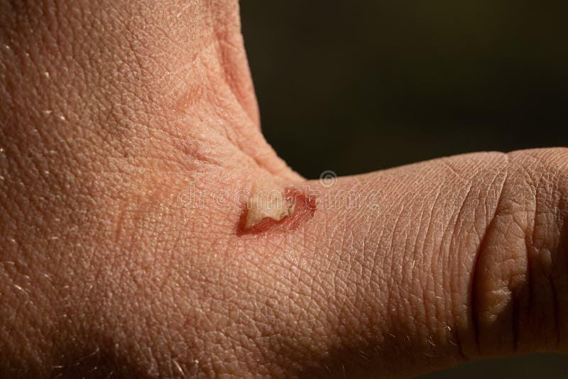 a burst Blister on a man& x27;s palm is caused by hard work stock photo